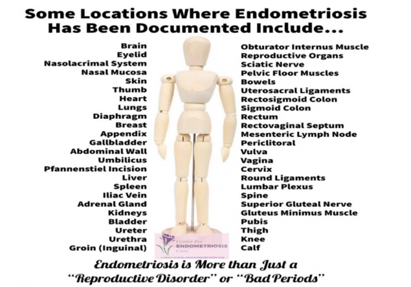 Шта је ендометриоза? Нови филм документује политику која стоји иза недовољно дијагностиковане болести